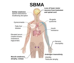 Spinal Muscular Atrophy