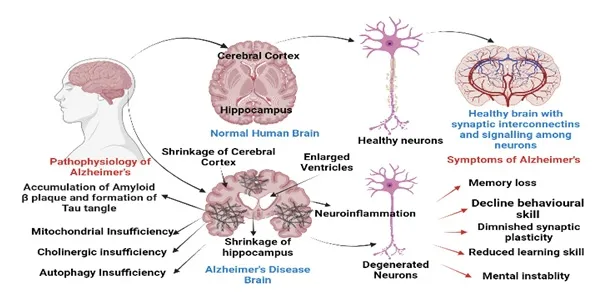 Pathophysiology, anatomy and symptoms of brain in Alzheimer’s disease
