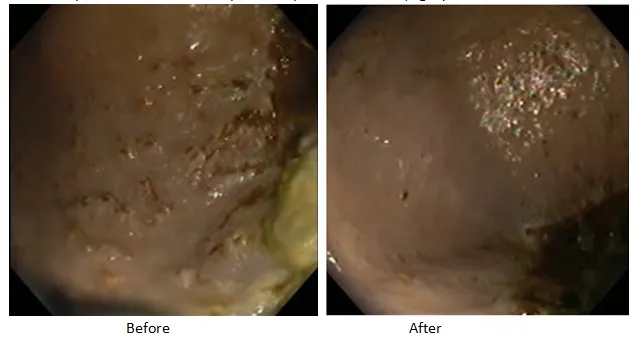 Ulcer wounds with red blood spots